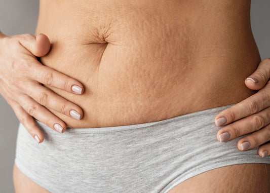 Stretch marks causes and how to avoid it